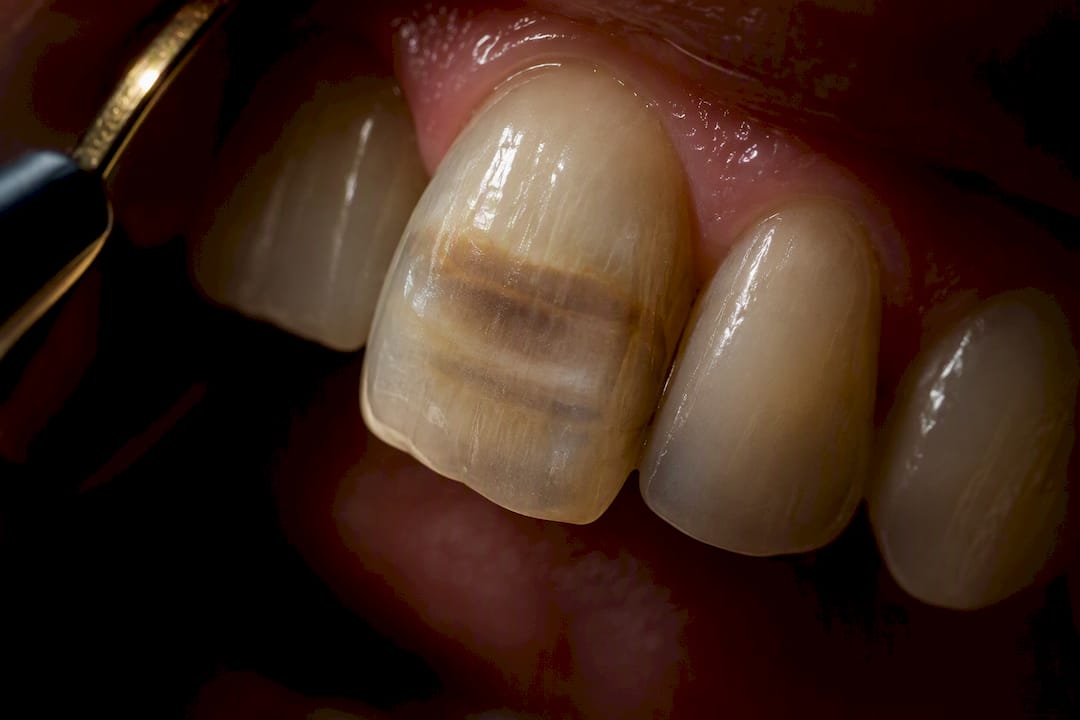 How UK Dentists Grade Tetracycline Teeth and When Whitening Fails