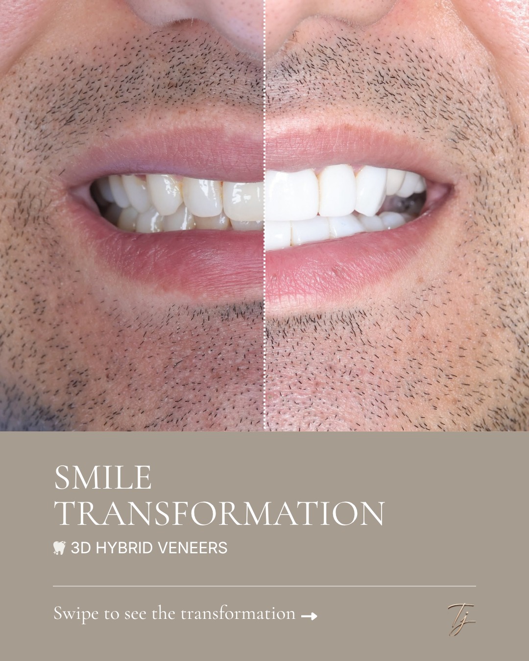 One of my favourite parts of creating a smile transformation is seeing all the planning come together in the final result. For this patient, we… — image 1 of 2