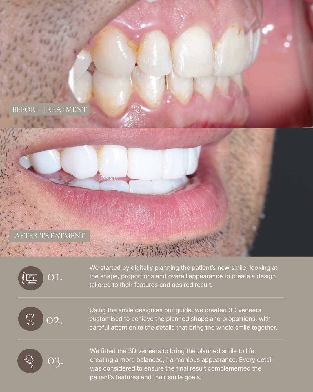 One of my favourite parts of creating a smile transformation is seeing all the planning come together in the final result. For this patient, we… — image 2 of 2