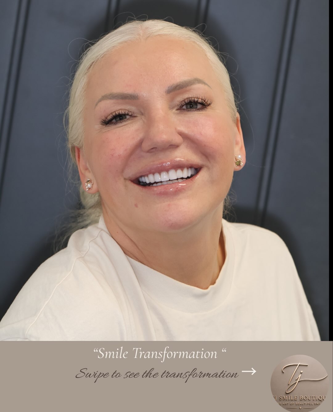 ✨ A smile worth celebrating. There’s nothing better than seeing that confidence at the end of a smile transformation. 🤎 This smile was carefully… — image 1 of 5