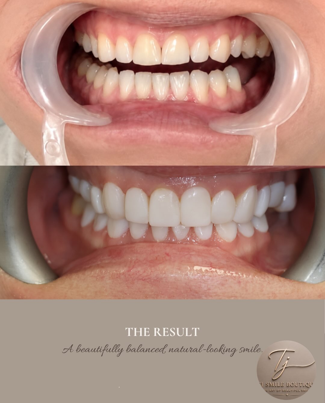 ✨ A smile worth celebrating. There’s nothing better than seeing that confidence at the end of a smile transformation. 🤎 This smile was carefully… — image 2 of 5