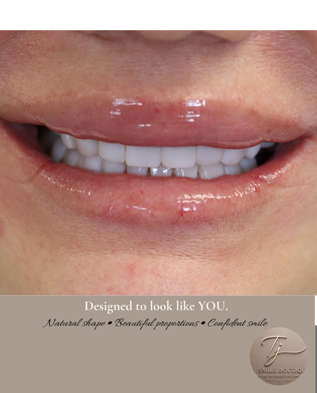 ✨ A smile worth celebrating. There’s nothing better than seeing that confidence at the end of a smile transformation. 🤎 This smile was carefully… — image 3 of 5