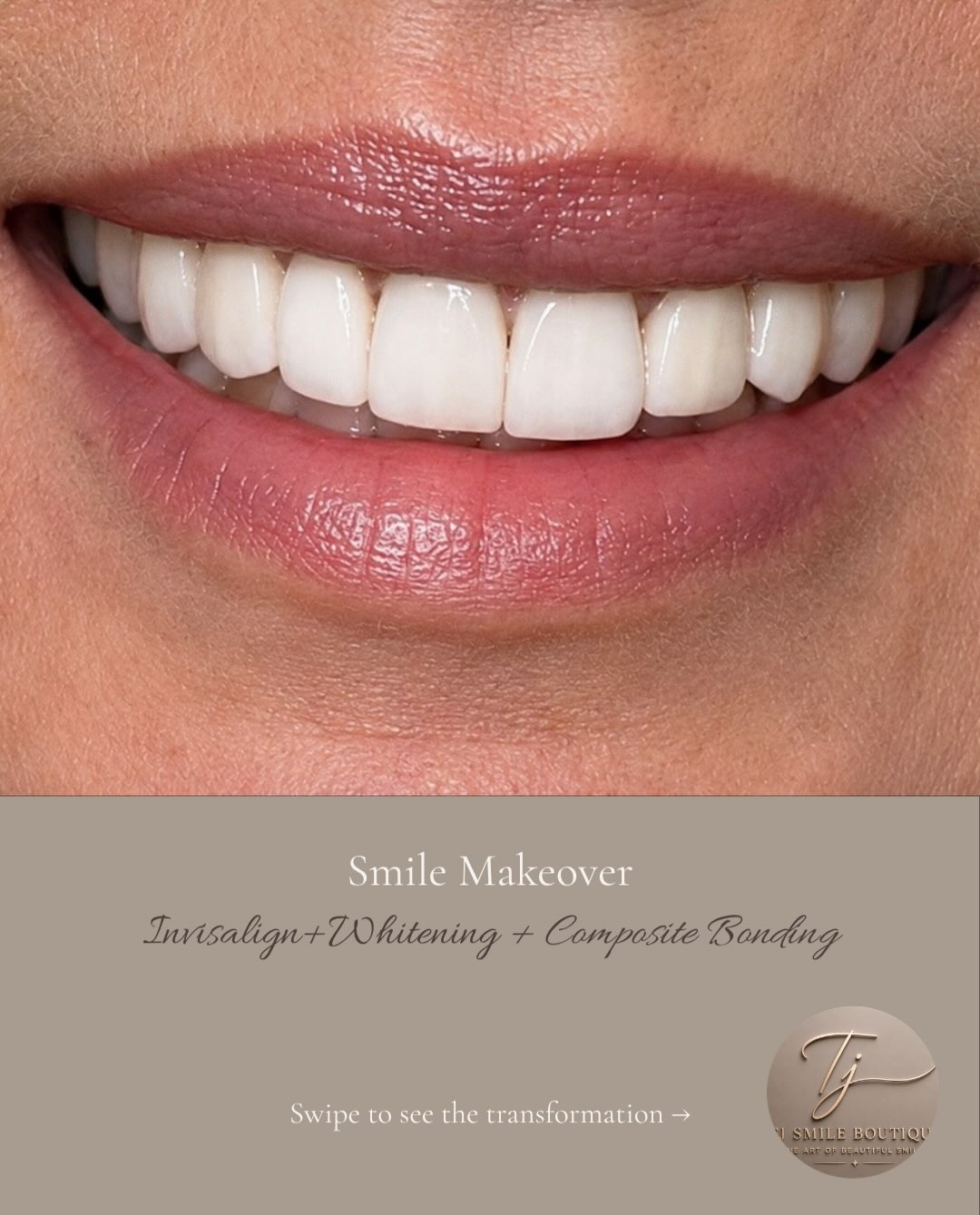 ✨ A smile transformed. A confidence restored. This beautiful smile journey combined Invisalign, professional teeth whitening and composite bonding to… — image 1 of 4