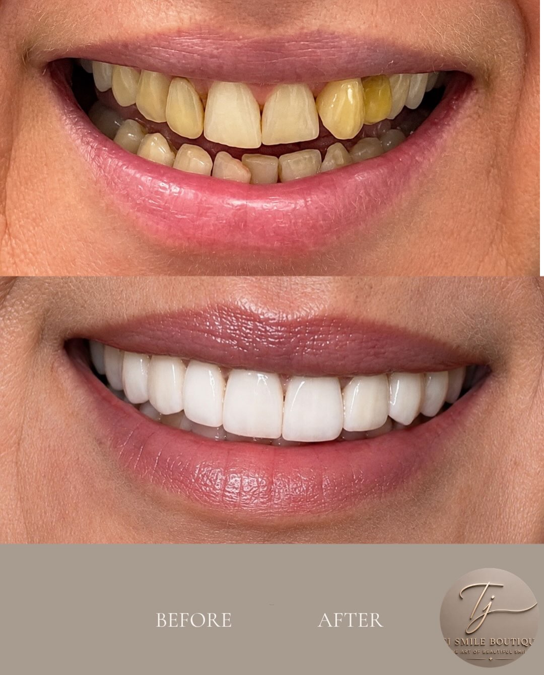 ✨ A smile transformed. A confidence restored. This beautiful smile journey combined Invisalign, professional teeth whitening and composite bonding to… — image 2 of 4