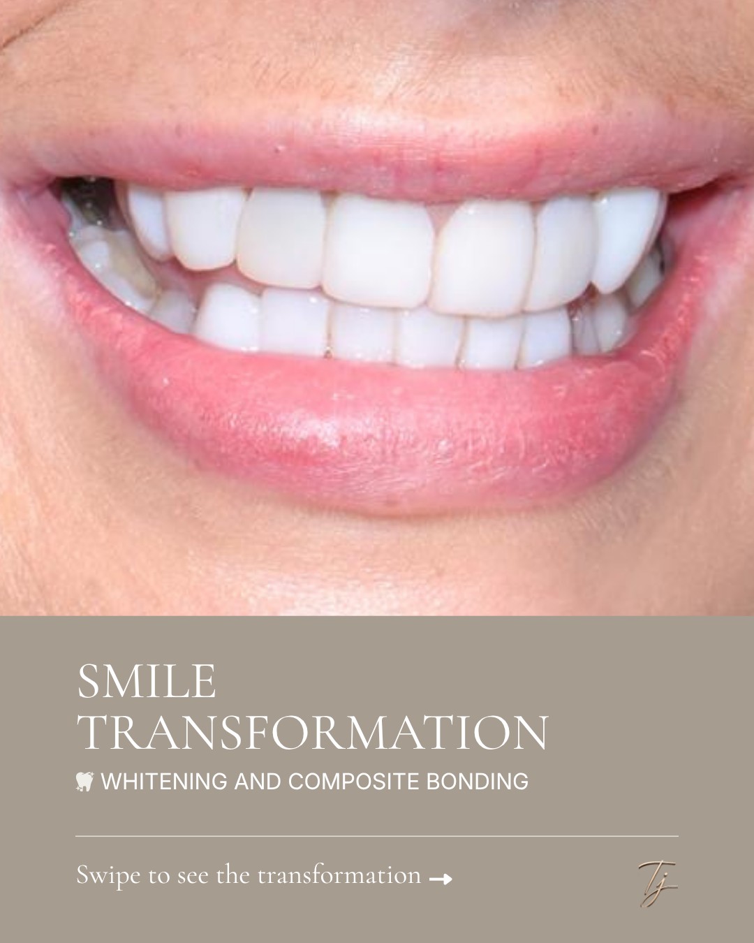 A beautifully enhanced, brighter smile here at TJ Smile Studio ✨ For this smile transformation we started with professional whitening before using… — image 1 of 2