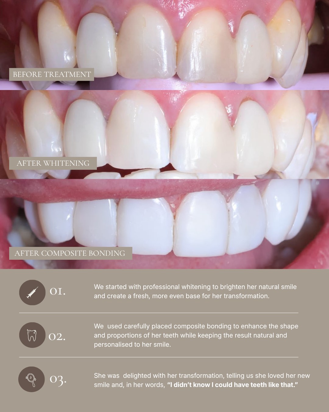 A beautifully enhanced, brighter smile here at TJ Smile Studio ✨ For this smile transformation we started with professional whitening before using… — image 2 of 2