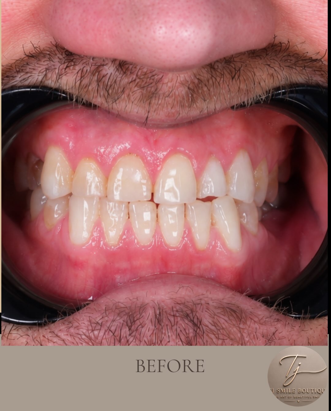 ✨ Smile Transformation with Composite Bonding ✨ Every smile is unique, and every treatment should be too. For this patient, the goal was to enhance… — image 2 of 4