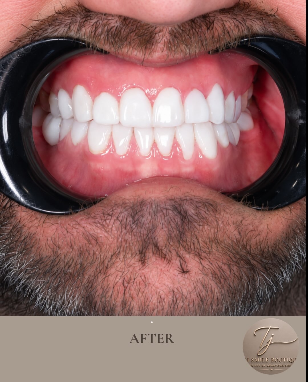 ✨ Smile Transformation with Composite Bonding ✨ Every smile is unique, and every treatment should be too. For this patient, the goal was to enhance… — image 3 of 4