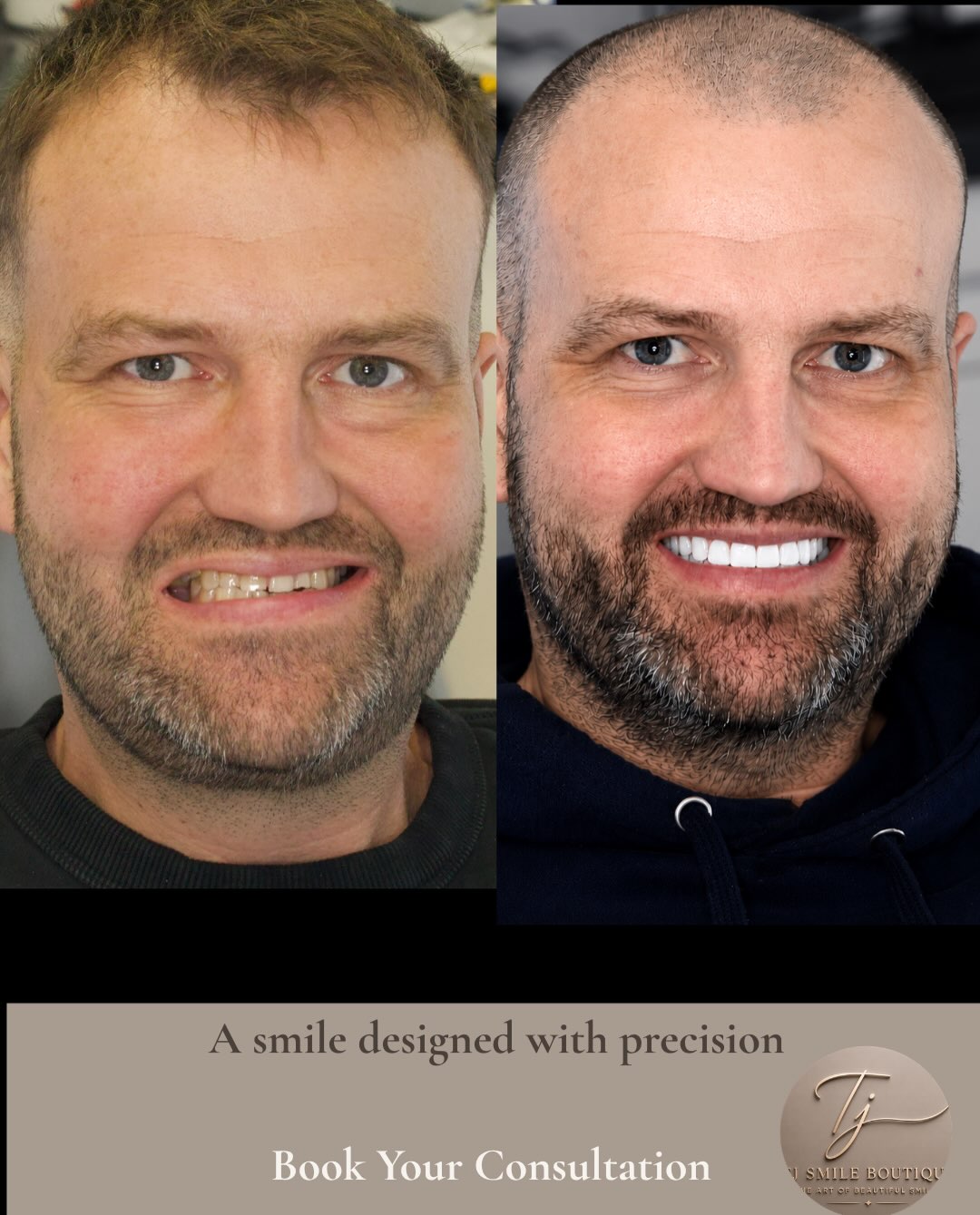 ✨ Smile Transformation with Composite Bonding ✨ Every smile is unique, and every treatment should be too. For this patient, the goal was to enhance… — image 4 of 4