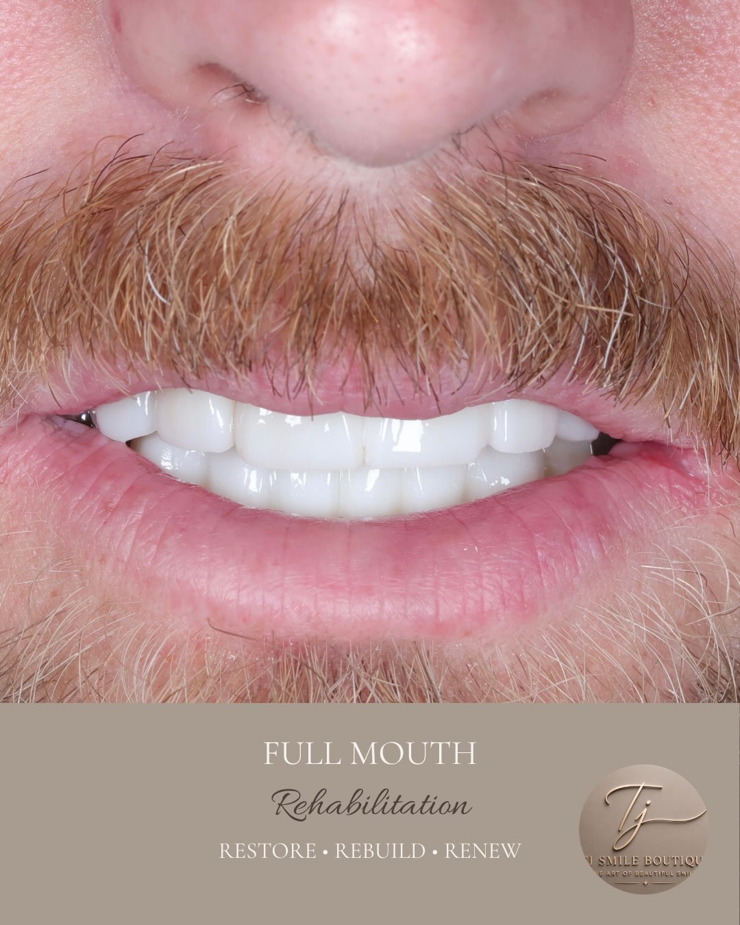 Restoring more than a smile. Restoring confidence.
Every smile has a story. This patient presented with severely broken, heavily worn and failing… — image 1 of 4