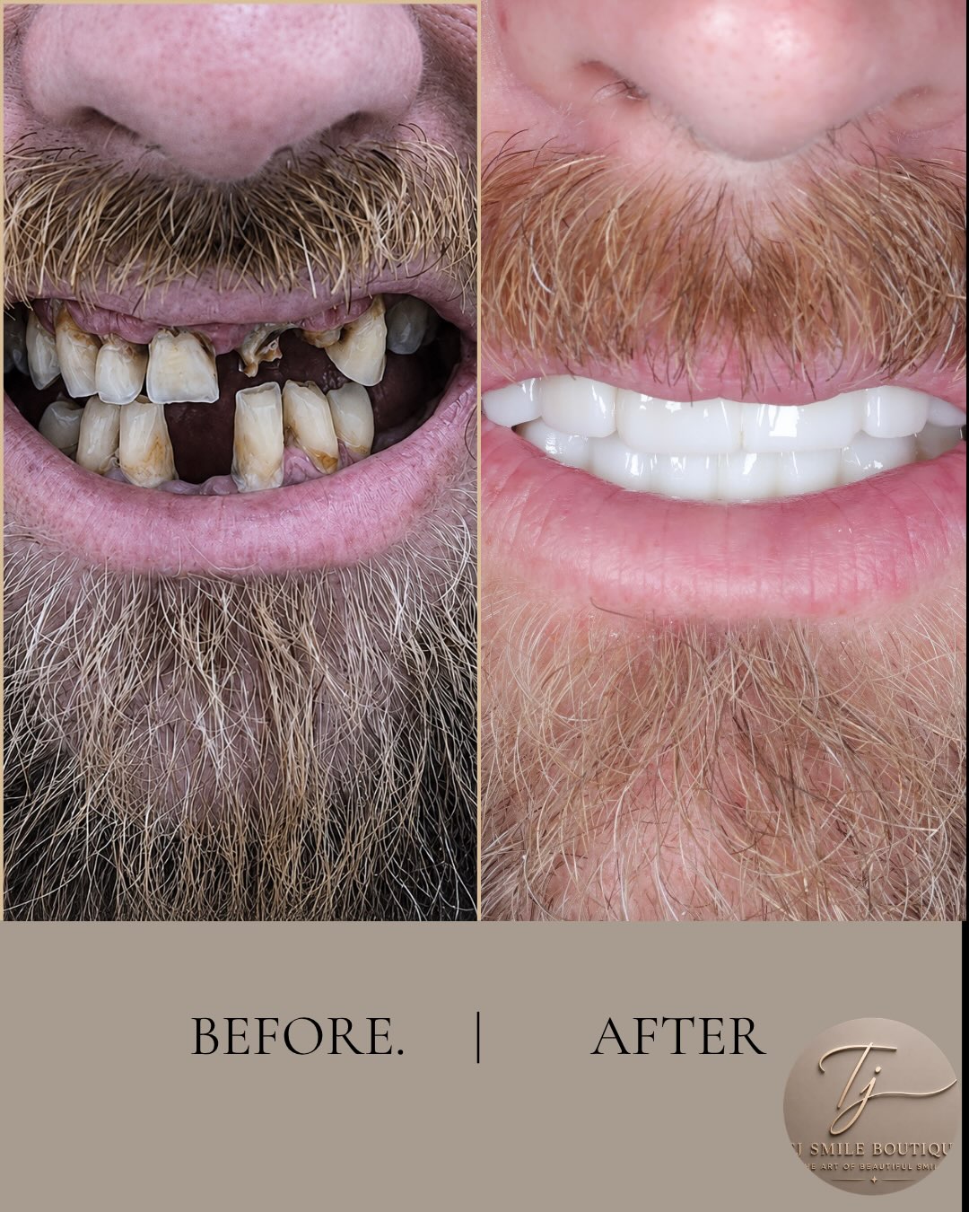 Restoring more than a smile. Restoring confidence.
Every smile has a story. This patient presented with severely broken, heavily worn and failing… — image 2 of 4