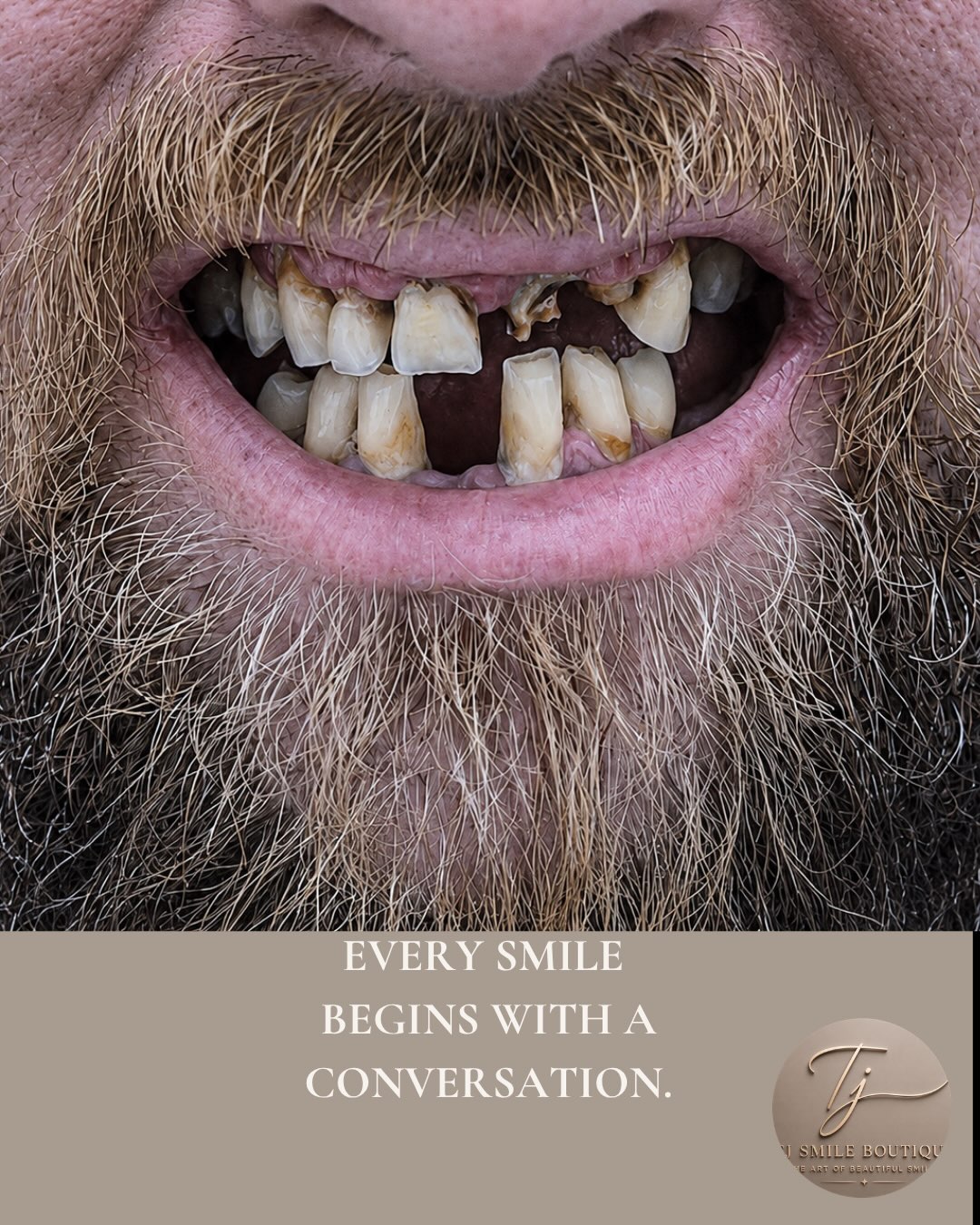 Restoring more than a smile. Restoring confidence.
Every smile has a story. This patient presented with severely broken, heavily worn and failing… — image 3 of 4