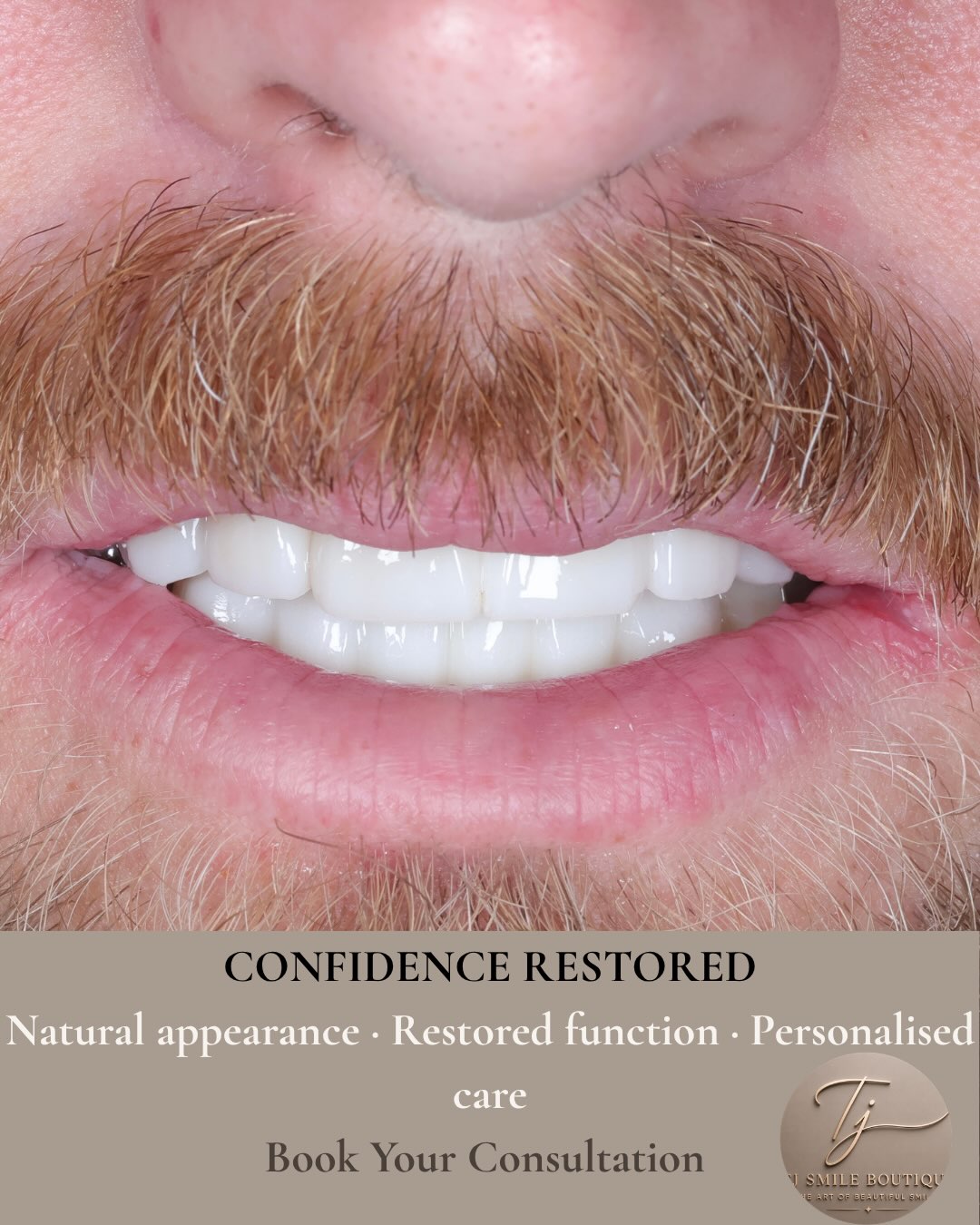 Restoring more than a smile. Restoring confidence.
Every smile has a story. This patient presented with severely broken, heavily worn and failing… — image 4 of 4