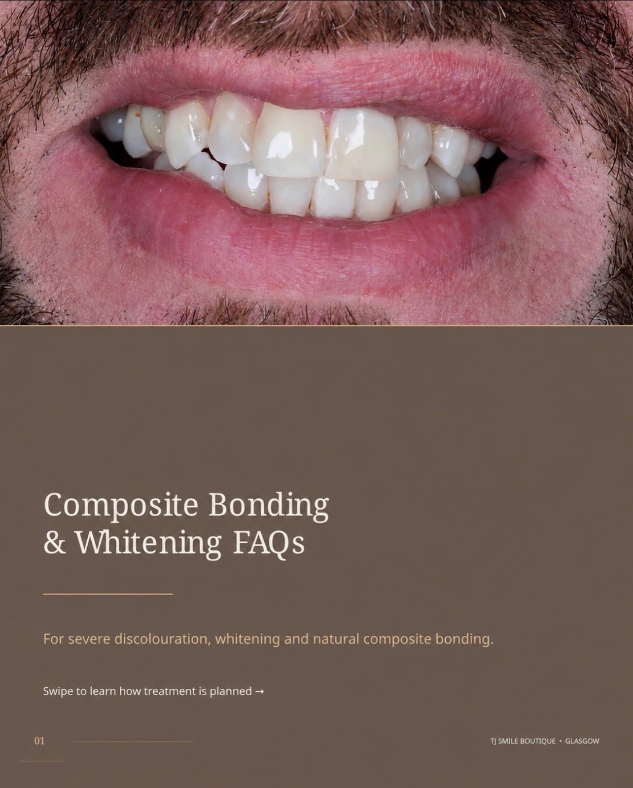 Composite bonding or teeth whitening — which comes first? ✨ For many smile-makeover cases, teeth whitening is completed first so the natural teeth… — image 1 of 12