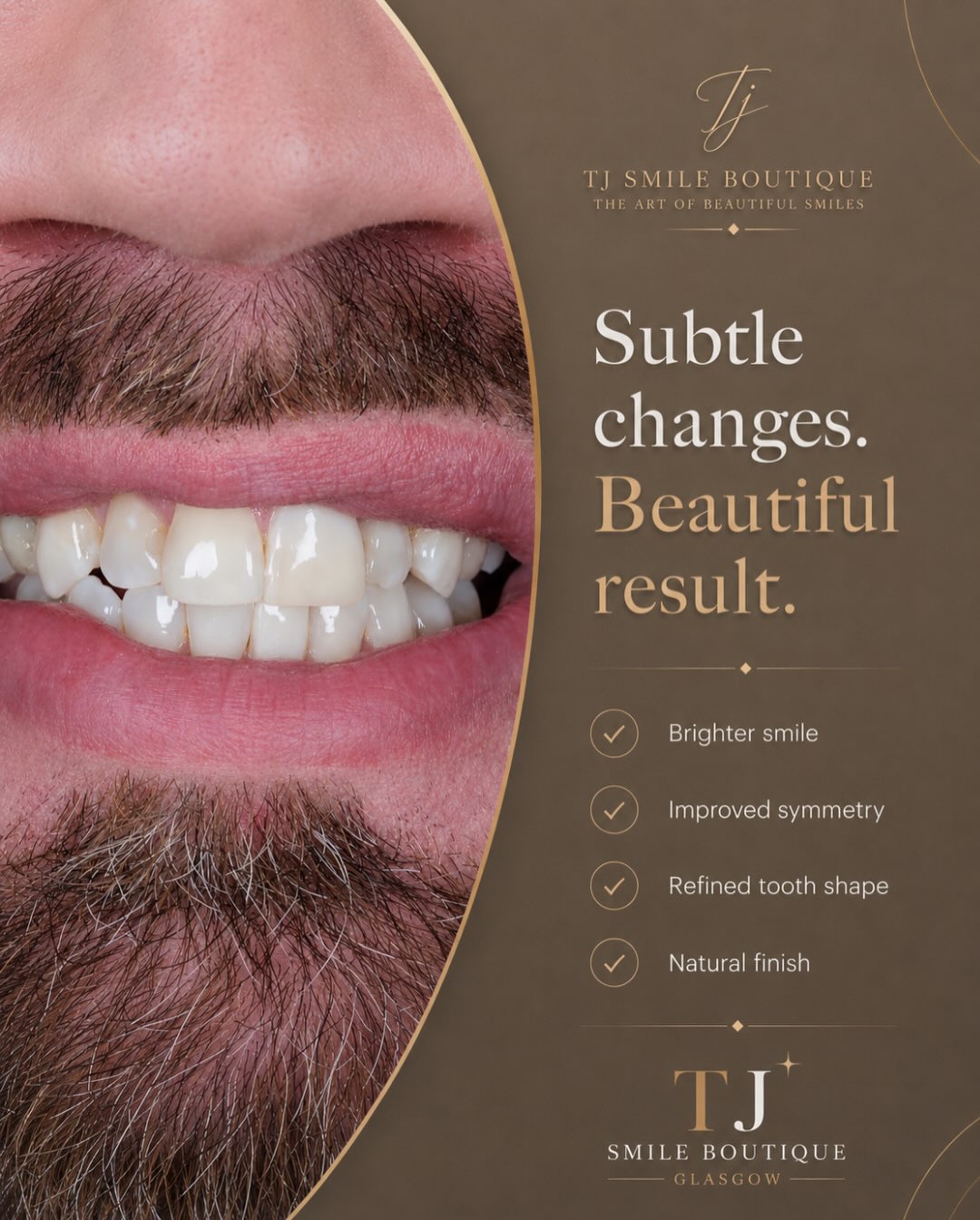 Composite bonding or teeth whitening — which comes first? ✨ For many smile-makeover cases, teeth whitening is completed first so the natural teeth… — image 11 of 12
