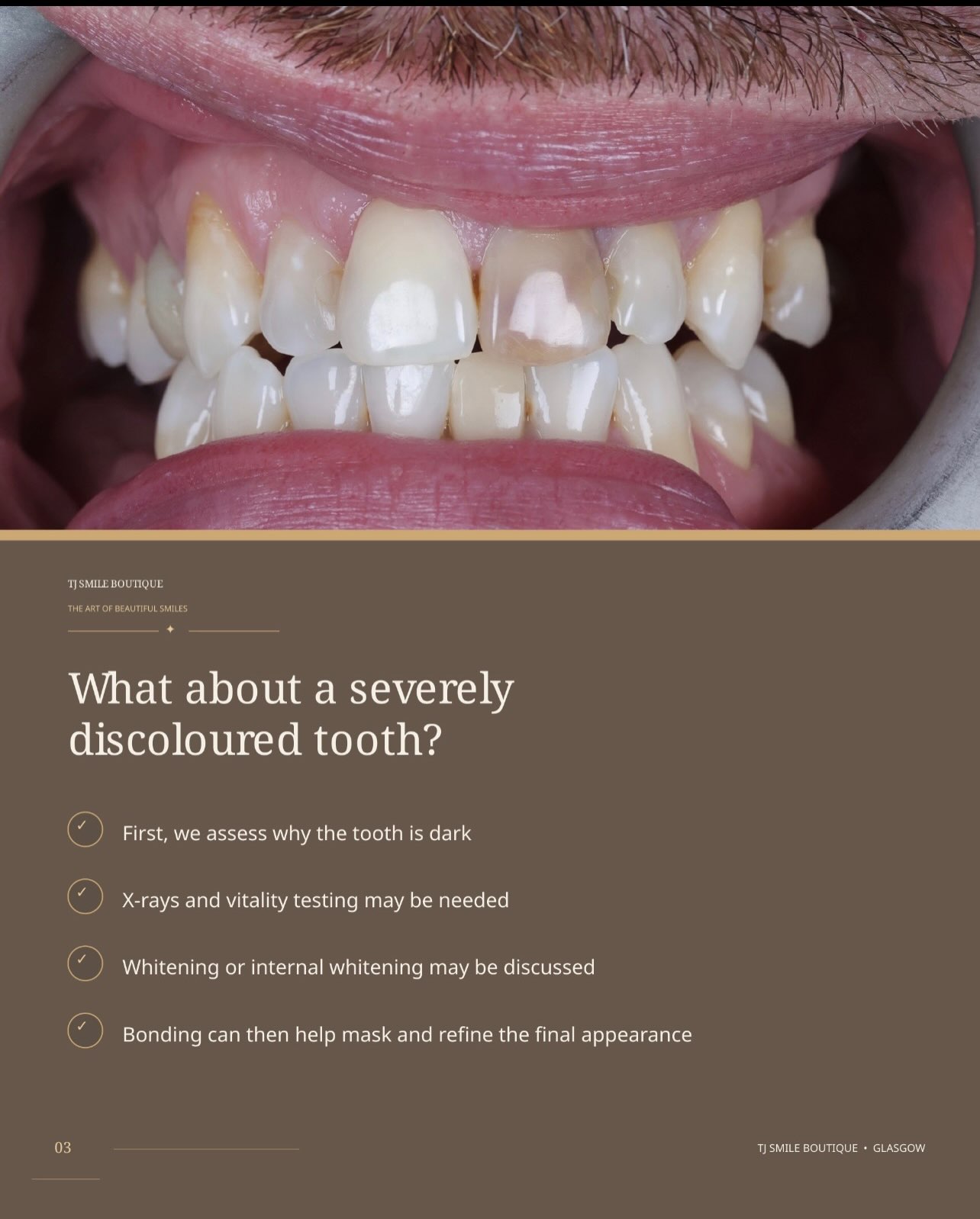 Composite bonding or teeth whitening — which comes first? ✨ For many smile-makeover cases, teeth whitening is completed first so the natural teeth… — image 3 of 12