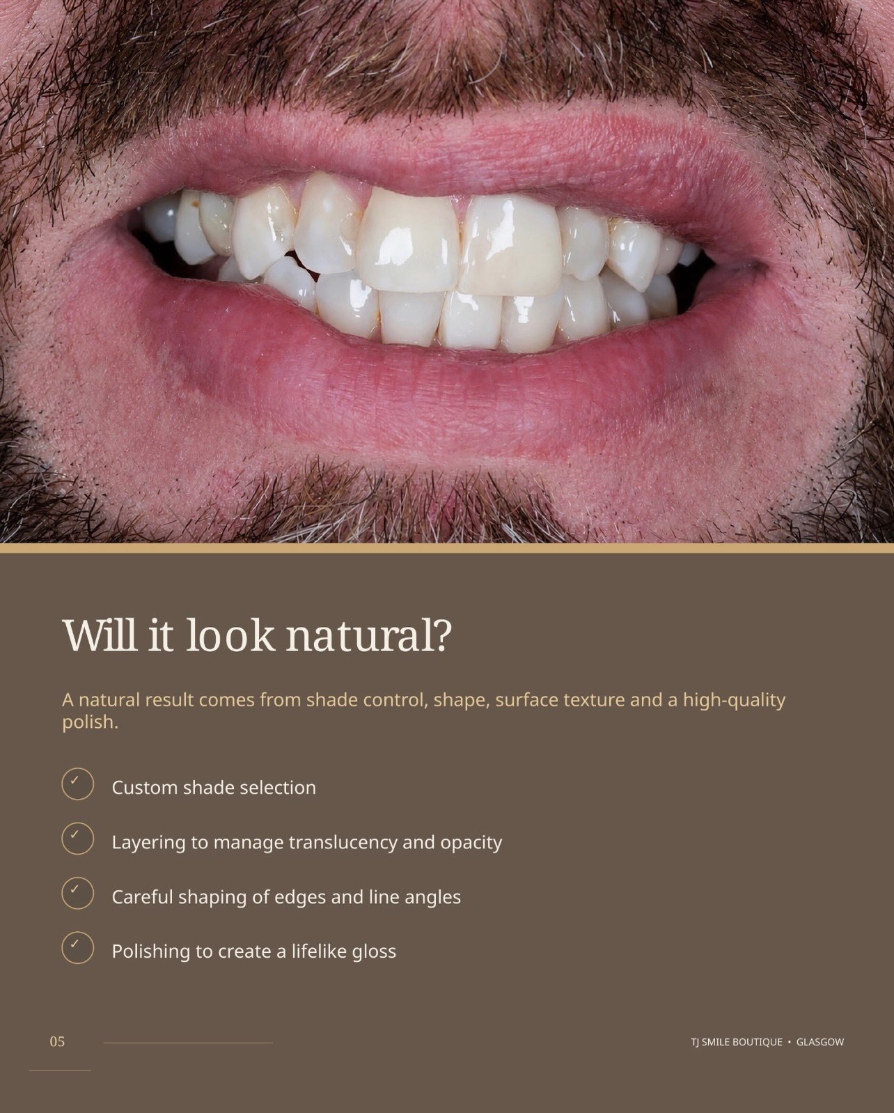 Composite bonding or teeth whitening — which comes first? ✨ For many smile-makeover cases, teeth whitening is completed first so the natural teeth… — image 5 of 12