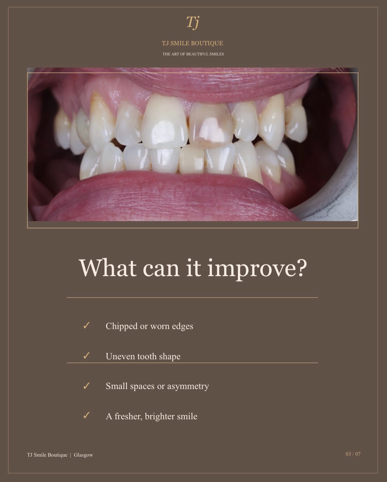 Composite bonding or teeth whitening — which comes first? ✨ For many smile-makeover cases, teeth whitening is completed first so the natural teeth… — image 6 of 12