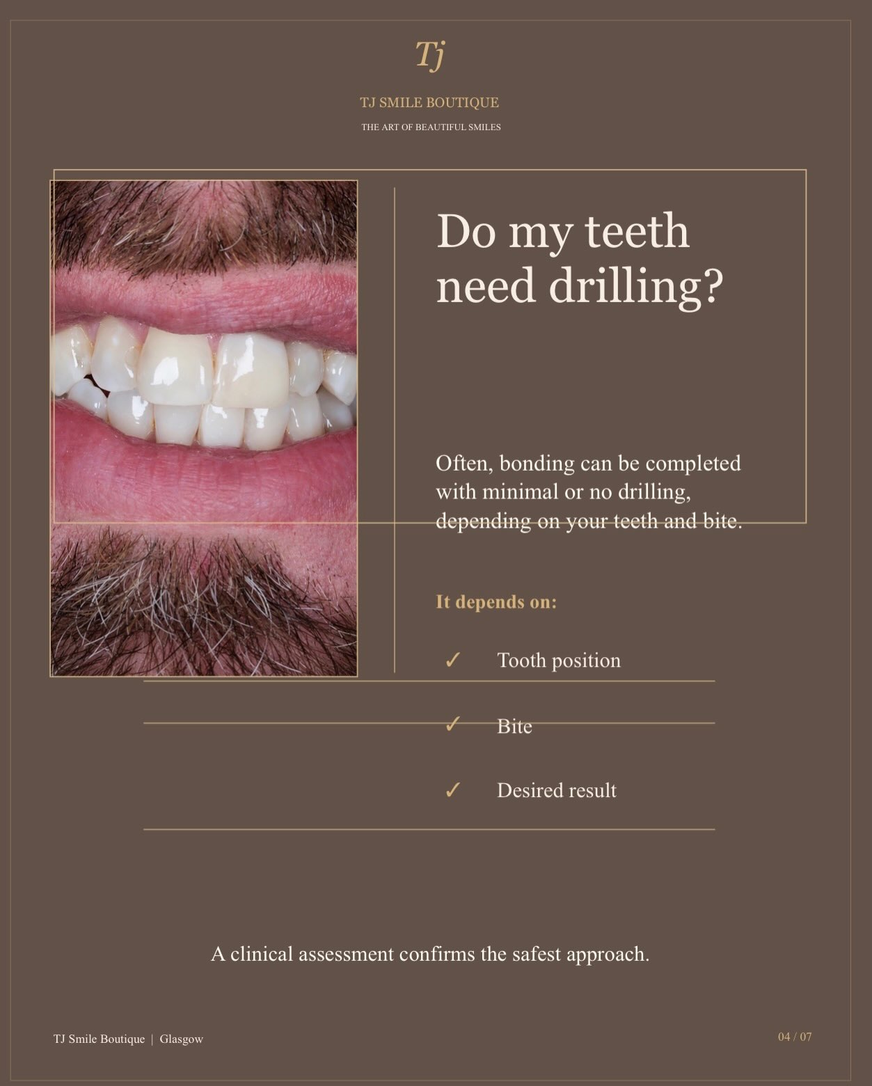 Composite bonding or teeth whitening — which comes first? ✨ For many smile-makeover cases, teeth whitening is completed first so the natural teeth… — image 7 of 12