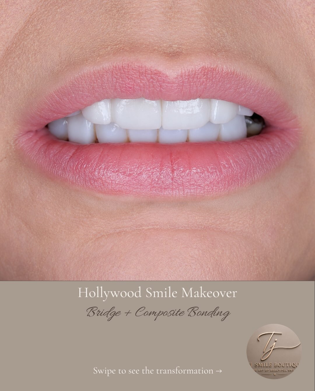 From missing teeth to a confident Hollywood smile ✨ This smile transformation was designed for a patient who wanted a brighter, fuller and more… — image 1 of 4