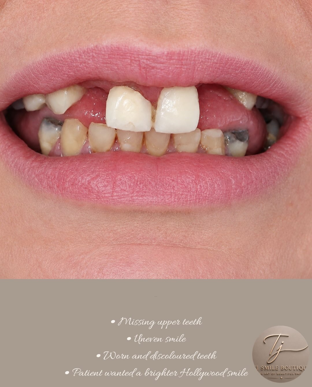From missing teeth to a confident Hollywood smile ✨ This smile transformation was designed for a patient who wanted a brighter, fuller and more… — image 2 of 4