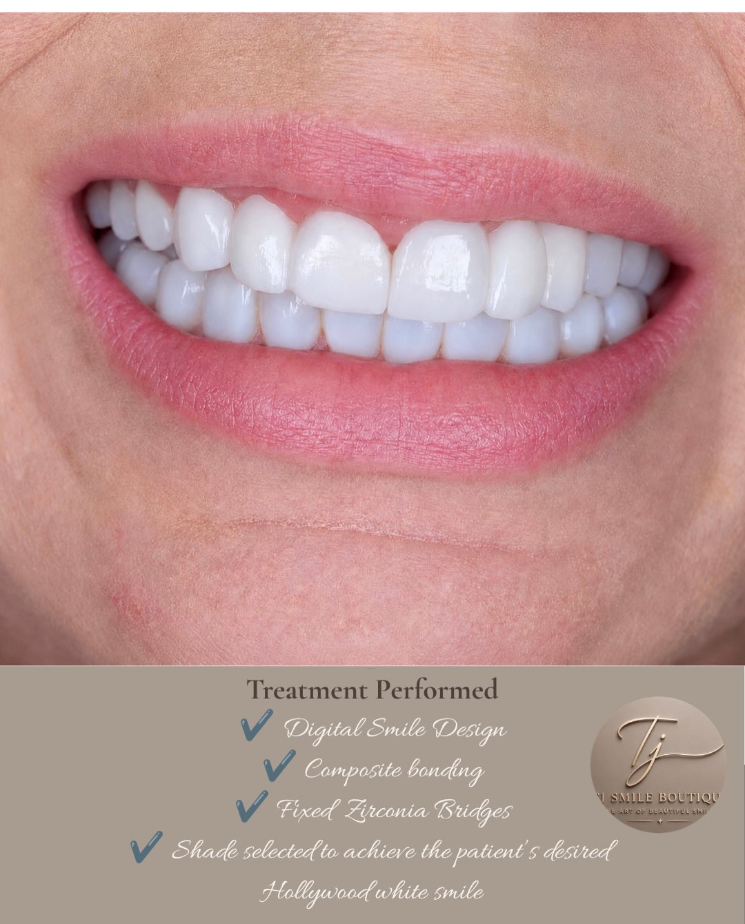 From missing teeth to a confident Hollywood smile ✨ This smile transformation was designed for a patient who wanted a brighter, fuller and more… — image 3 of 4