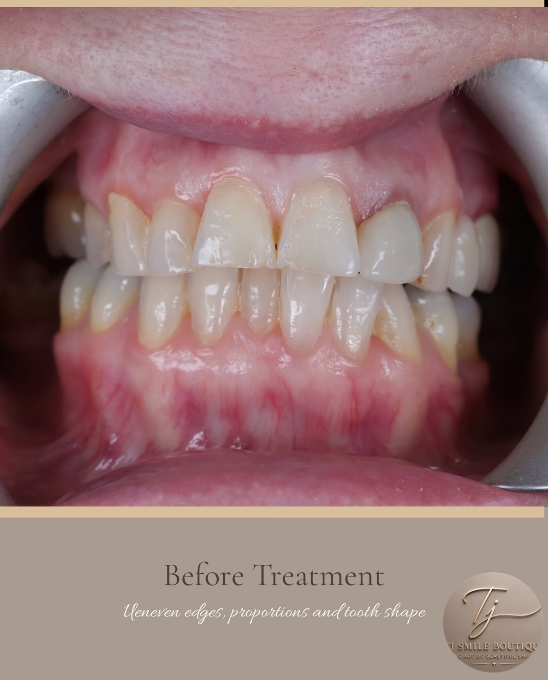 ✨ A smile doesn’t have to be perfect to be beautiful—it just needs the right balance. For this patient, the goal wasn’t simply to create a whiter… — image 1 of 3