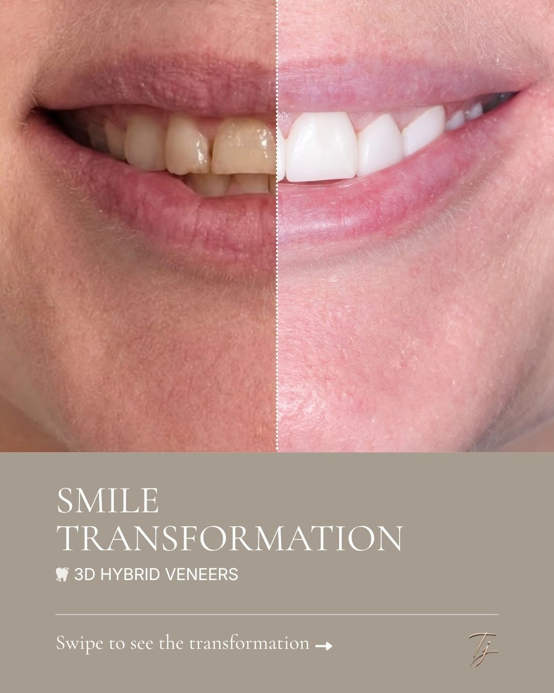 What’s possible when your smile is designed specifically around you? This patient’s transformation was created using our 3D hybrid veneers, with the… — image 1 of 2