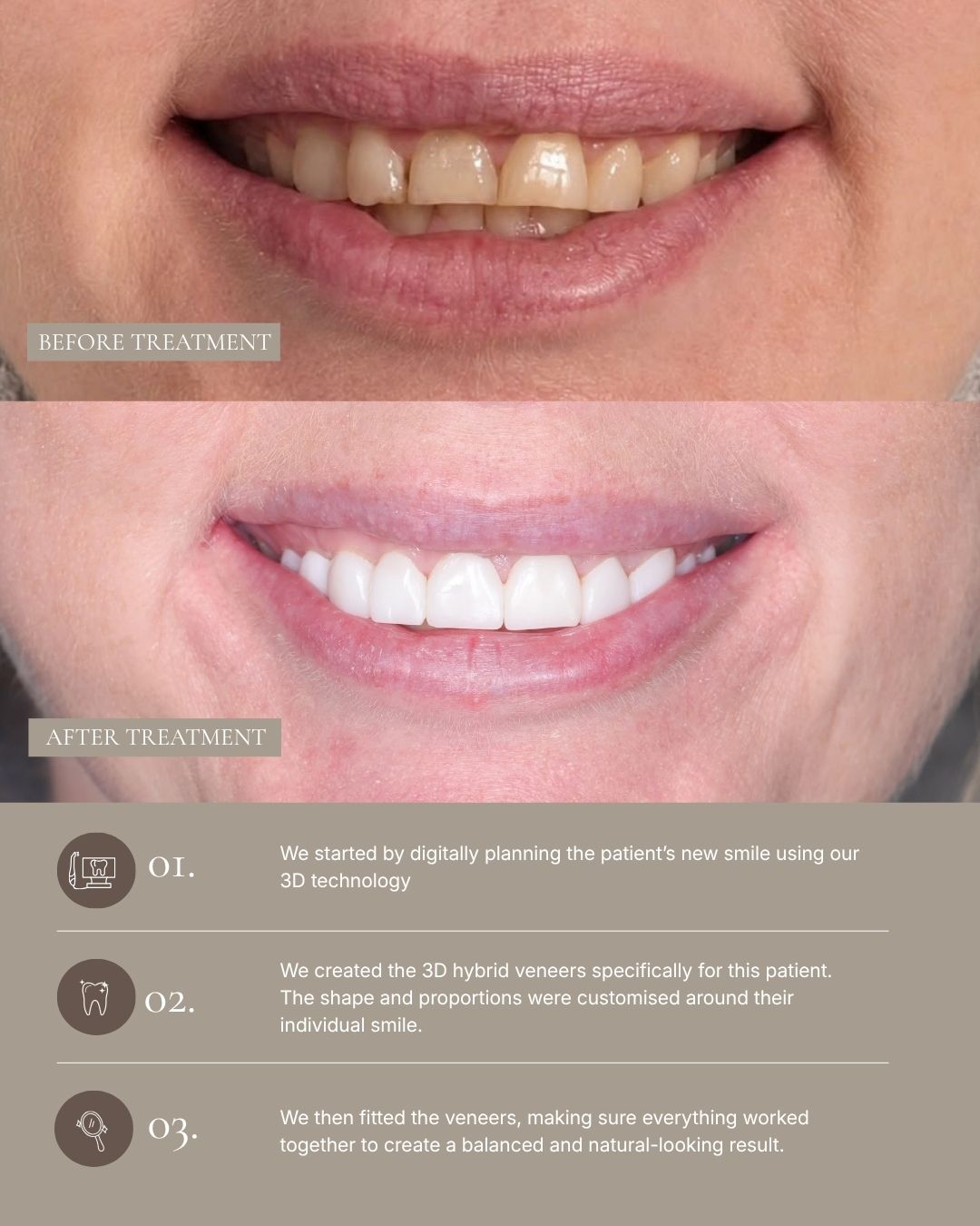 What’s possible when your smile is designed specifically around you? This patient’s transformation was created using our 3D hybrid veneers, with the… — image 2 of 2