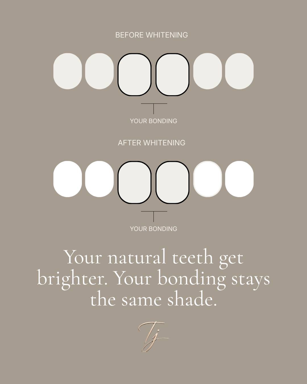 Whitening after bonding is the most expensive mistake I see. And it's completely avoidable. Composite bonding and veneers are colour-matched to your… — image 3 of 5